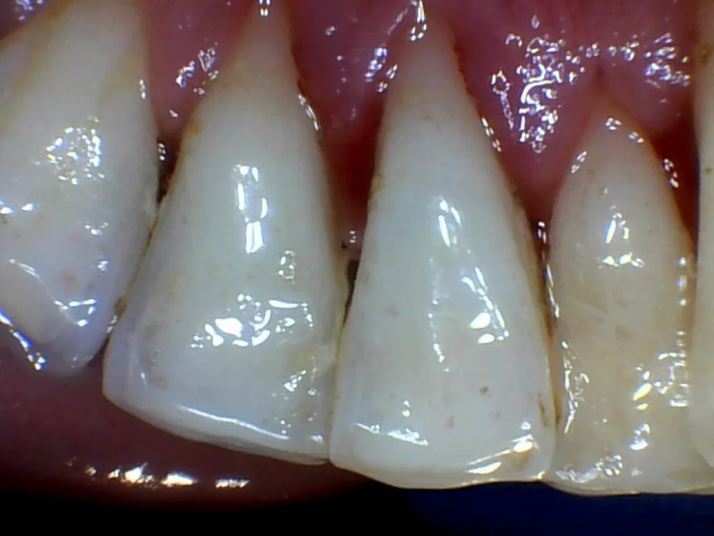 After: front teeth cleaned, stains and tartar removed