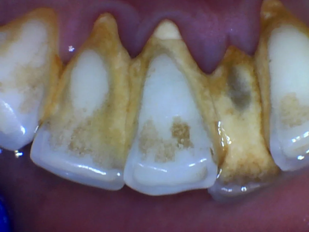 Before: front teeth with brown staining and tartar