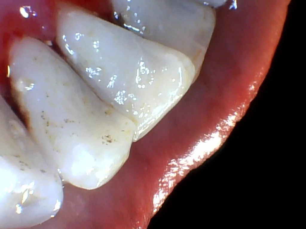 After: heavy tartar removed, teeth and gumline cleaned