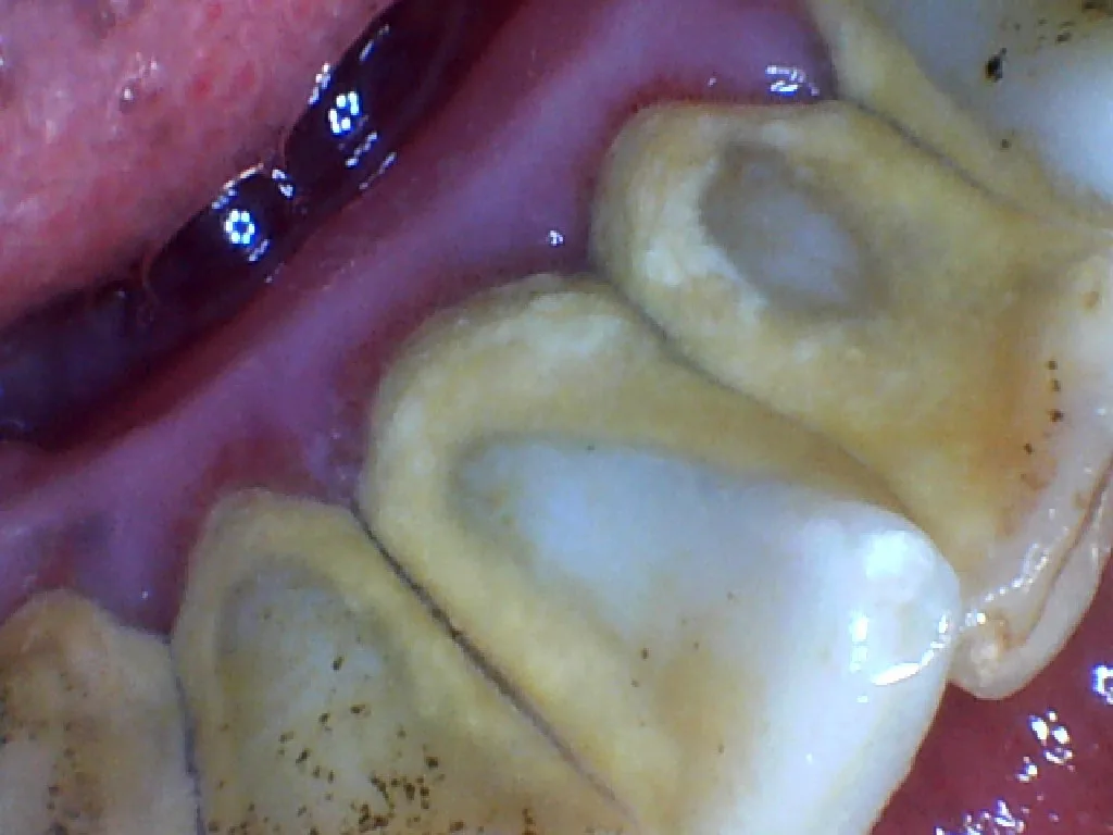 Before: heavy tartar build-up along the lower teeth
