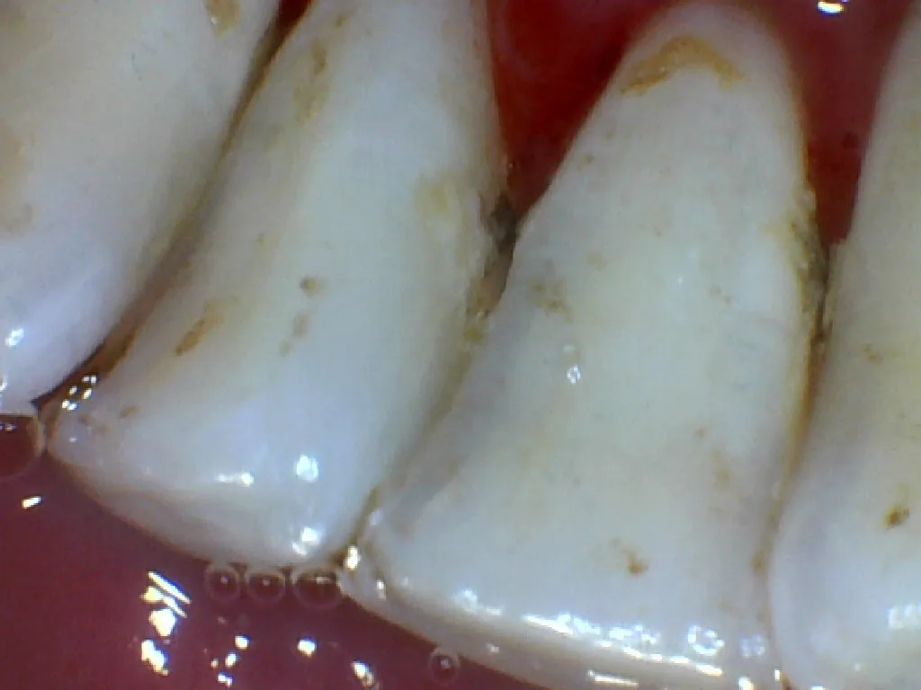 After: teeth cleaned and polished, staining removed