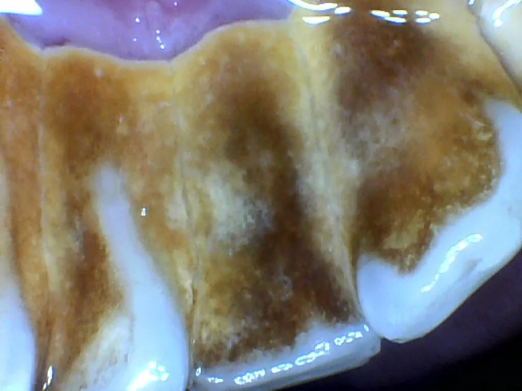 Before: teeth with heavy brown staining